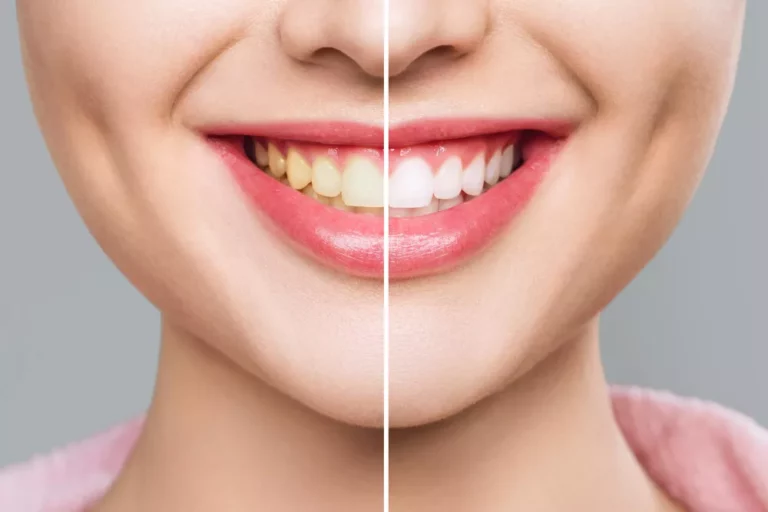 Teeth Whitening